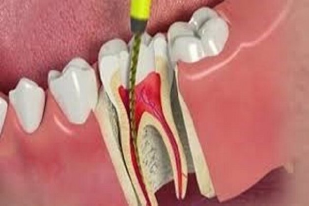 عصب کشی ، ایمپلنت دندان و دندان مصنوعی