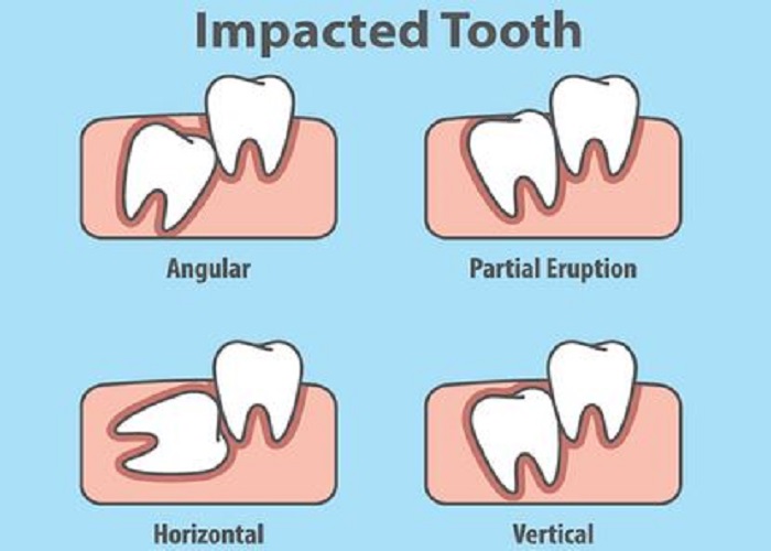 دندان نهفته چیست و باید با آن چه کرد؟