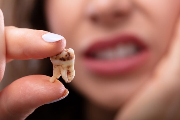 علت پوسیدگی دندان در کودکان و بزرگسالان چیست؟نحوه درمان آن