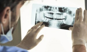 سیر تا پیاز رادیوگرافی دندان