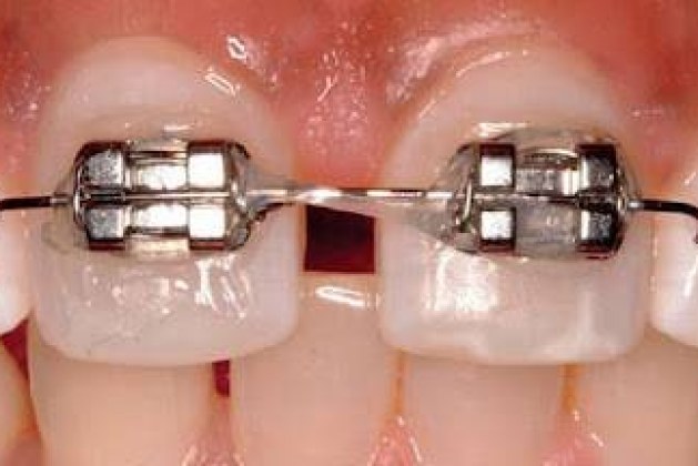 روش‌های ارتودنسی دو دندان جلو