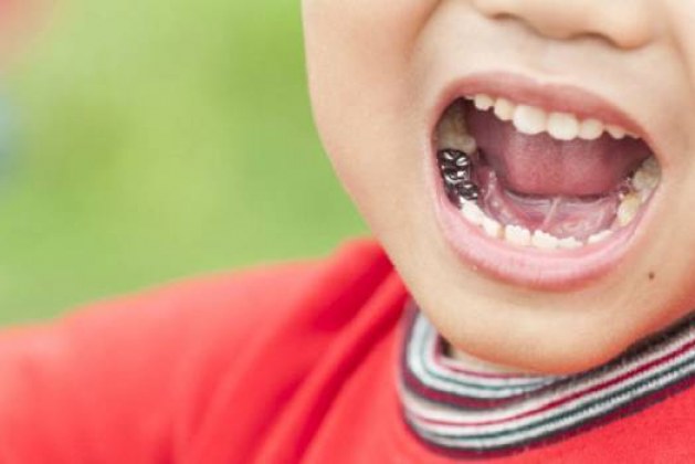 روکش دندان شیری کودکان، یک ترمیم مطمئن