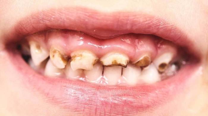 علت دندان درد کودکان