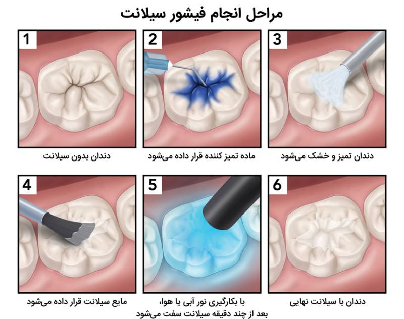 فیشورسیلانت دندان کودکان