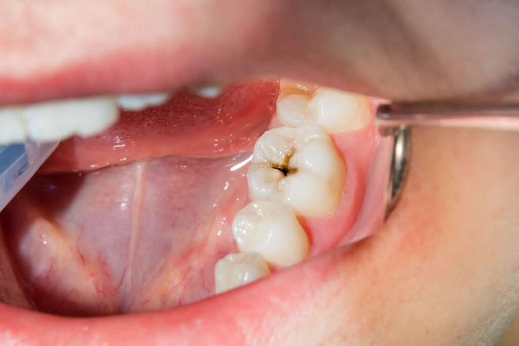 پوریدگی دندان