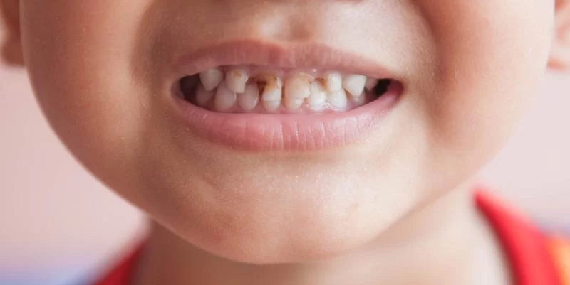پیشگیری از پوشیدگی ریشه دندان