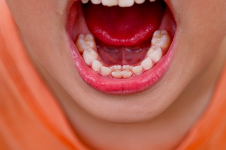 دندان شیری