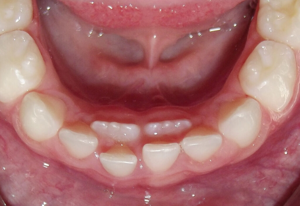  دندان شیری