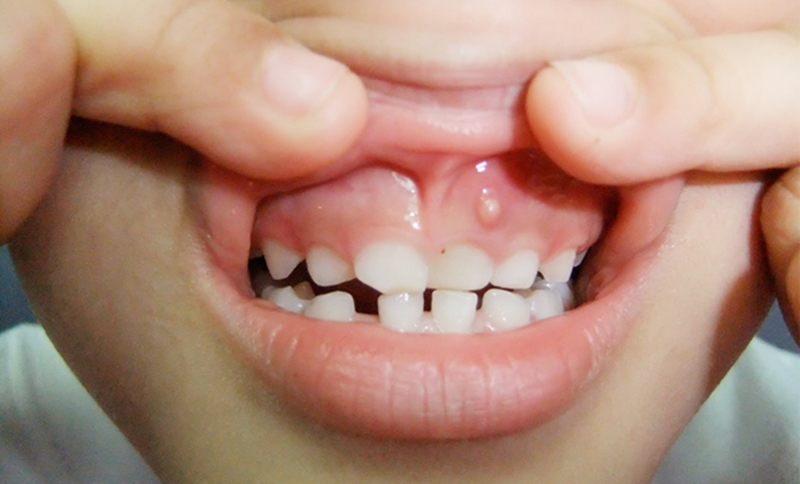  آبسه دندان کودک