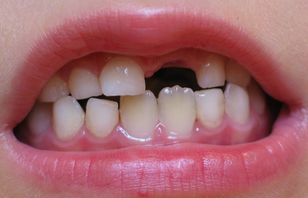  دندان شیری