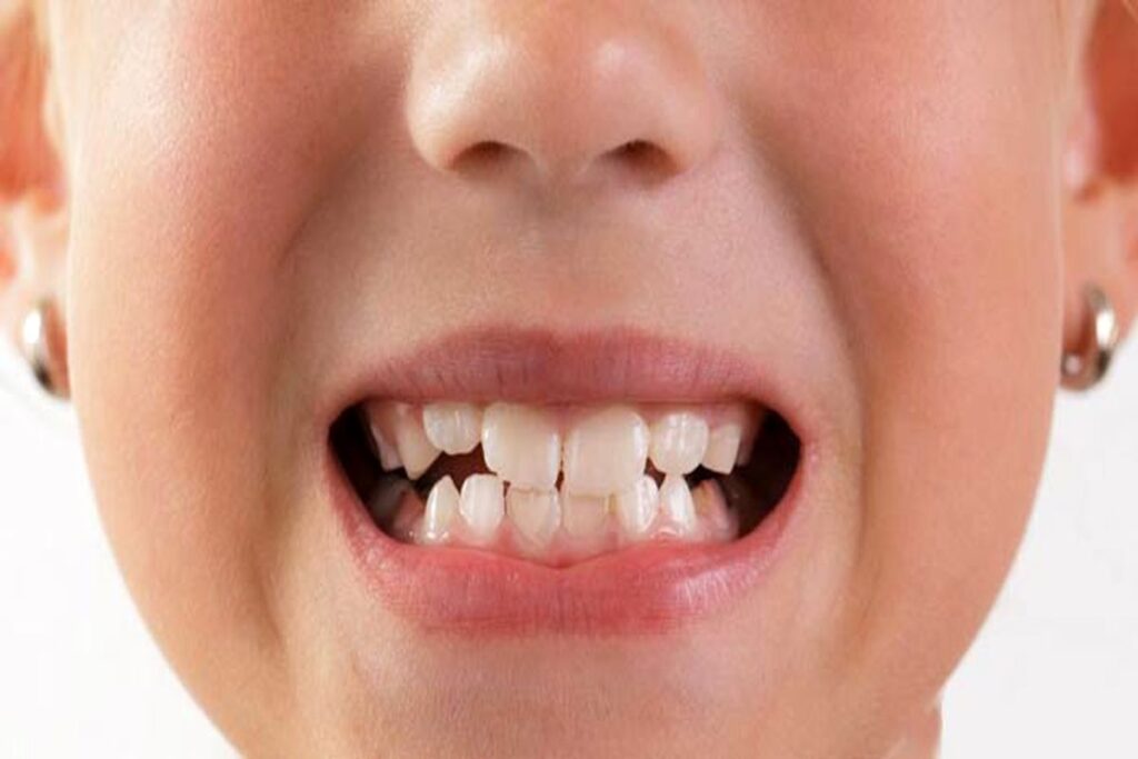 درمان دندان قروچه در کودکان