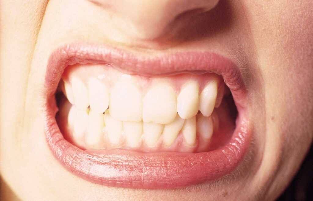 عوامل ایجاد دندان قروچه