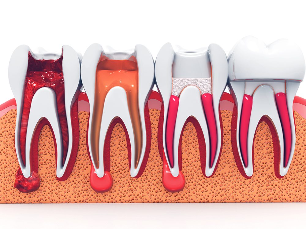 درمان پوسیدگی دندان در خانه