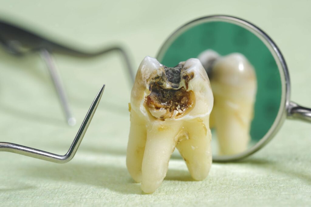 محل‌های شایع وجود دندان خراب