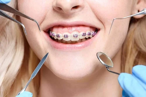 ارتودنسی دو دندان جلو