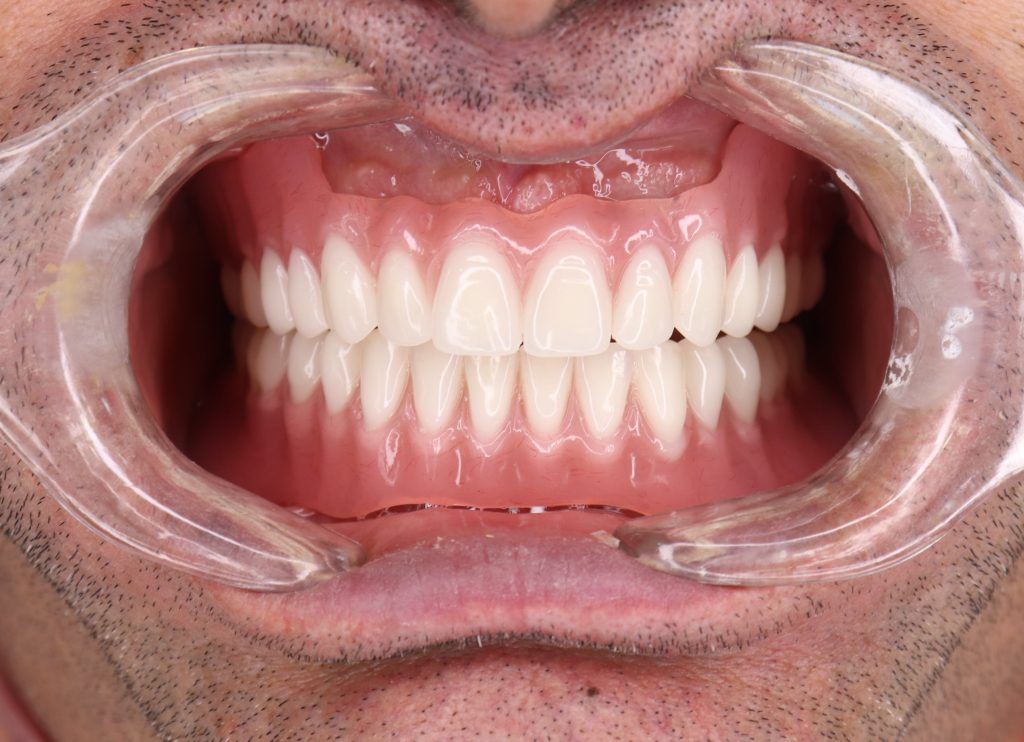اوردنچر دندان