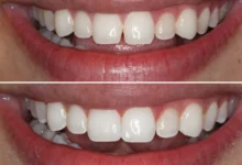 باندینگ زیبایی دندان