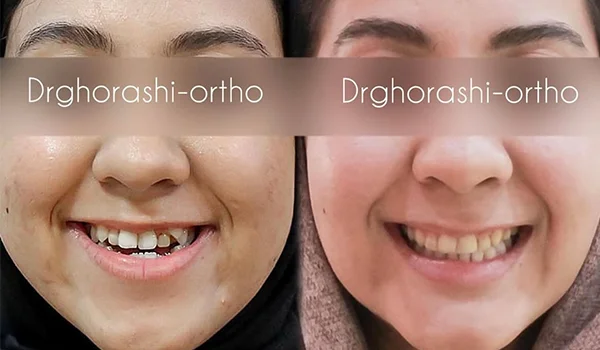 نمونه درمان بهترین متخصص ارتودنسی غرب تهران