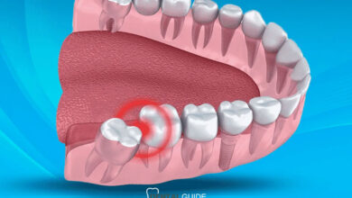 جراحی دندان عقل نهفته بدون بخیه با لیزر؛ تکنولوژی نوین در دندانپزشکی مدرن