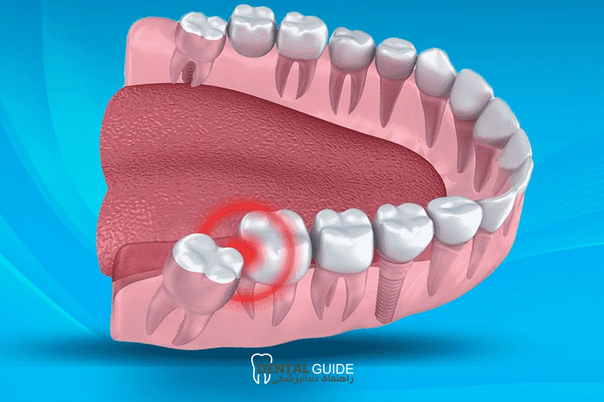 جراحی دندان عقل نهفته بدون بخیه با لیزر؛ تکنولوژی نوین در دندانپزشکی مدرن