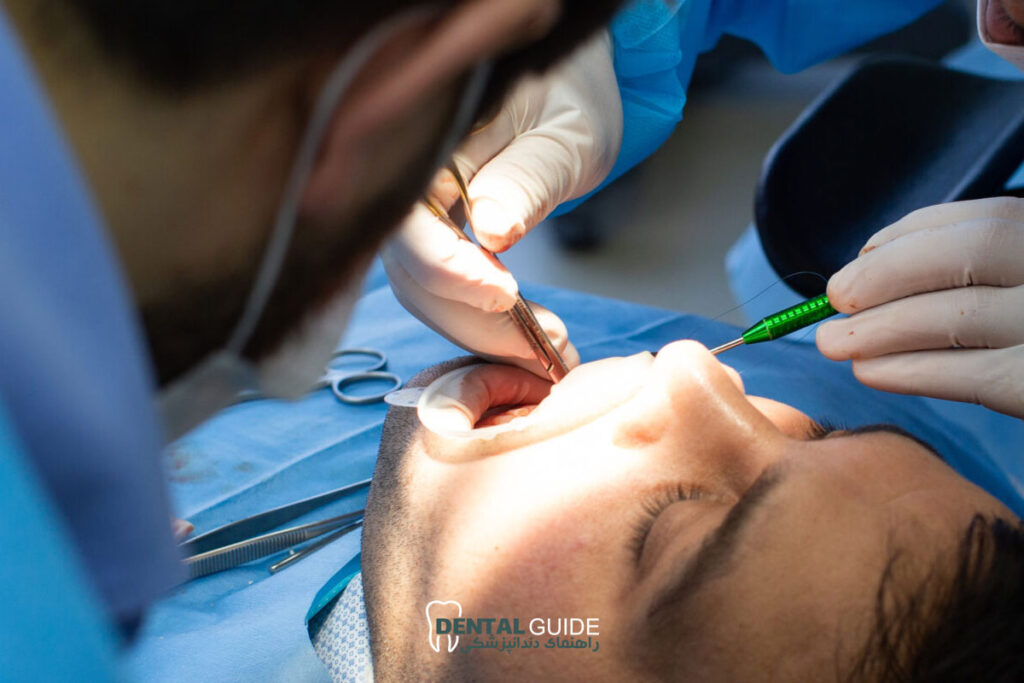 جراحی دندان عقل نهفته بدون بخیه با لیزر؛ تکنولوژی نوین در دندانپزشکی مدرن