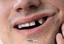 ارتباط از دست دادن دندان ها با افزایش خطر بستری در بیمارستان؛ بررسی یافته های جدید تحقیقات کانادایی