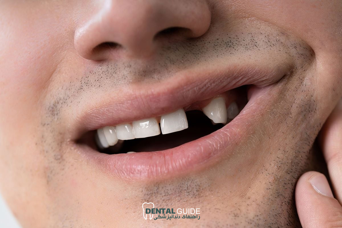 ارتباط از دست دادن دندان ها با افزایش خطر بستری در بیمارستان؛ بررسی یافته های جدید تحقیقات کانادایی