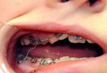اگر براکت ارتودنسی کنده شد چه کنیم؟