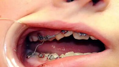 اگر براکت ارتودنسی کنده شد چه کنیم؟