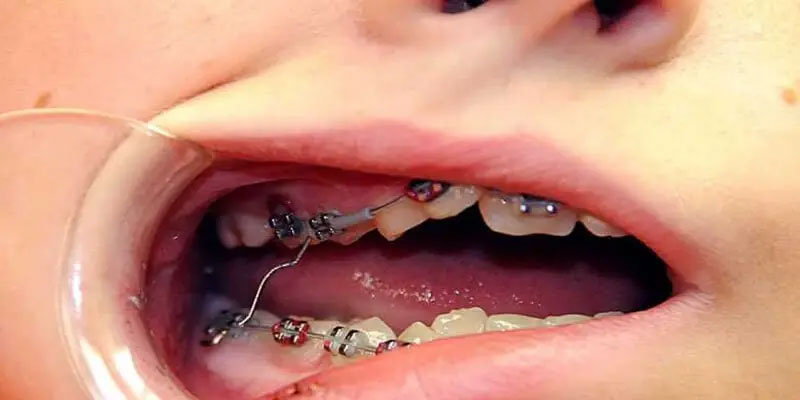 اگر براکت ارتودنسی کنده شد چه کنیم؟