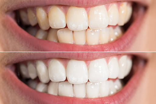 بلیچینگ با روش Zoom Whitening