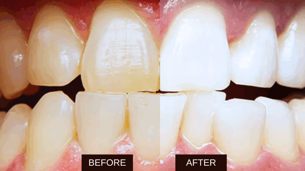 بلیچینگ دندان چیست