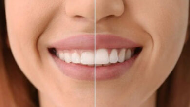 سفید کردن دندان و لیفت لثه با لیزر؛ هزینه و مراحل انجام