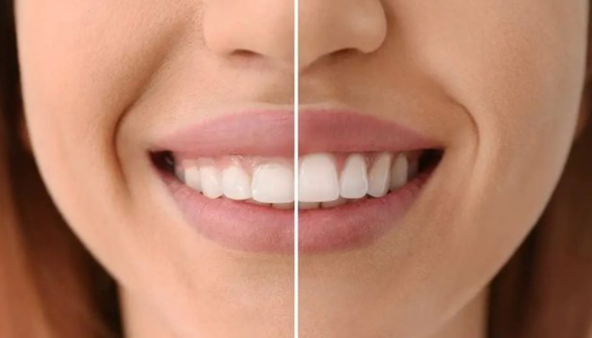 سفید کردن دندان و لیفت لثه با لیزر؛ هزینه و مراحل انجام
