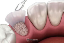 بهترین روش ایمپلنت دندان بدون نیاز به پیوند استخوان در سال 1404