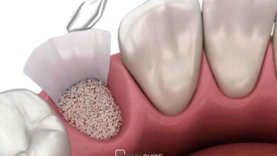بهترین روش ایمپلنت دندان بدون نیاز به پیوند استخوان در سال 1404