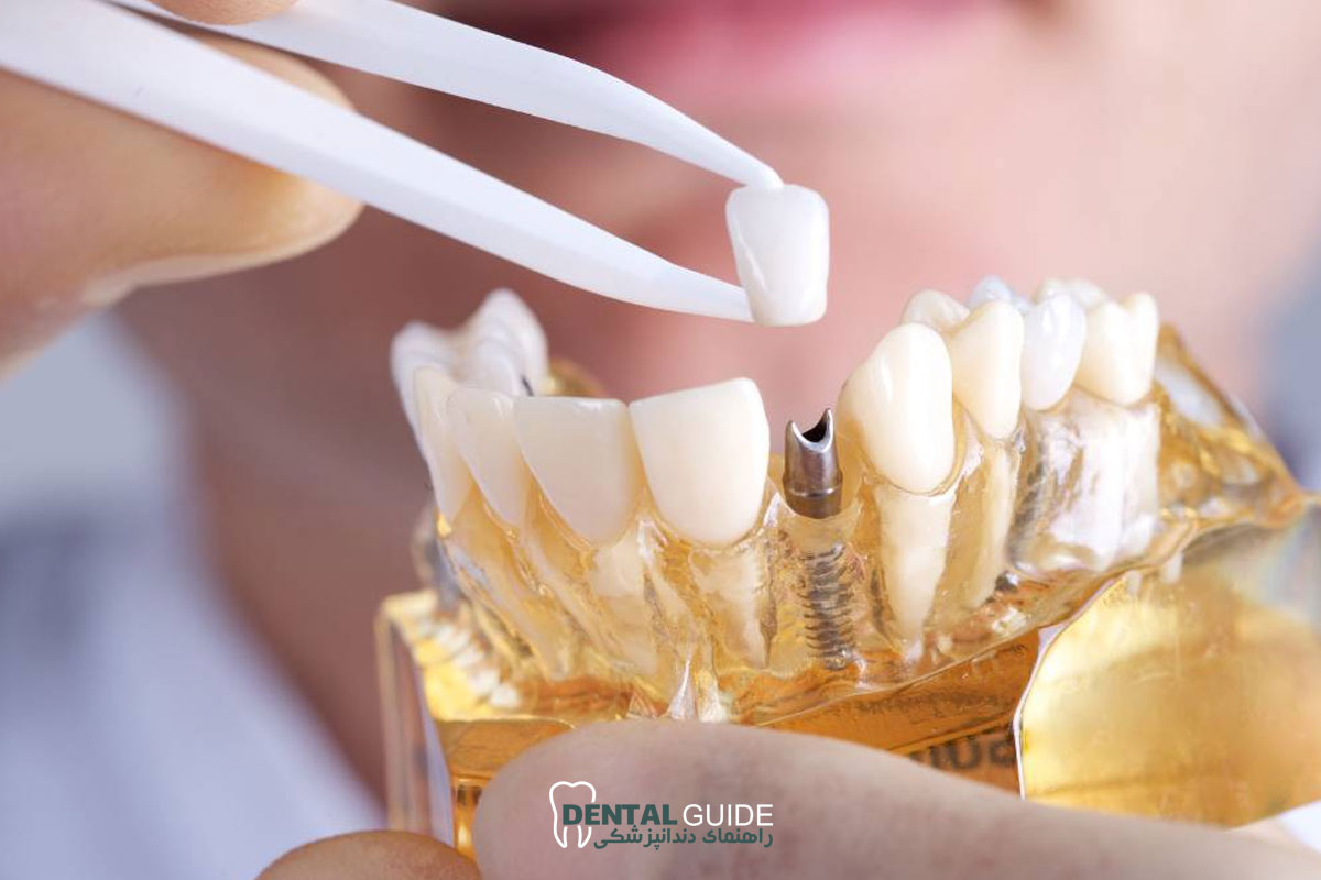 ارتودنسی و ایمپلنت همزمان؛ آیا امکان پذیر است؟