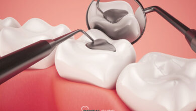 مواد پرکننده دندان کدام بهتر است؟ مقایسه آمالگام، کامپوزیت و متریال های جدید
