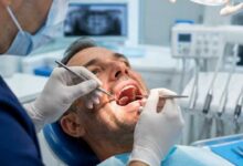 اقدامات قبل از لمینت دندان چیست؟+بررسی 0 تا 100 نکات آن