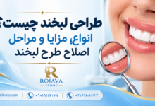 طراحی لبخند چیست؟ معرفی انواع روش های اصطلاح لبخند، قیمت