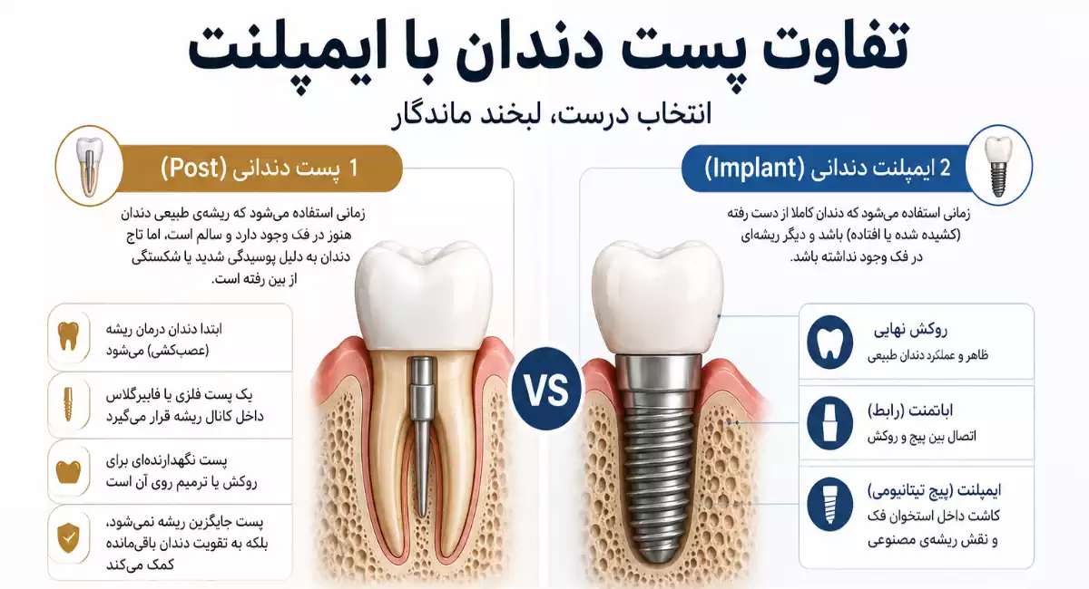 تفاوت پست دندان با ایمپلنت و ساختار هر روش