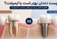 مقایسه پست و روکش دندان با ایمپلنت