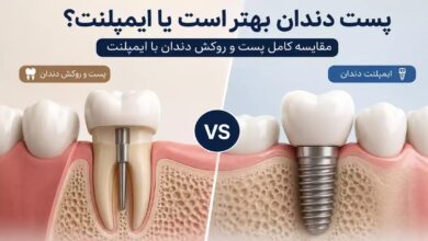 مقایسه پست و روکش دندان با ایمپلنت