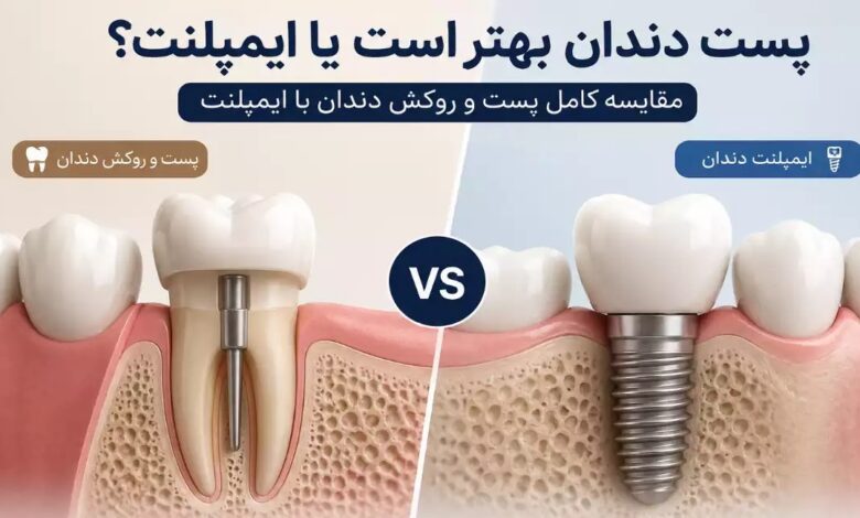 مقایسه پست و روکش دندان با ایمپلنت