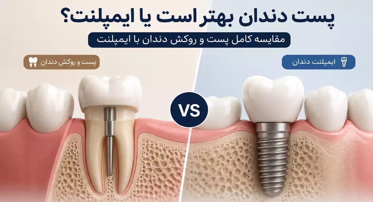 مقایسه پست و روکش دندان با ایمپلنت